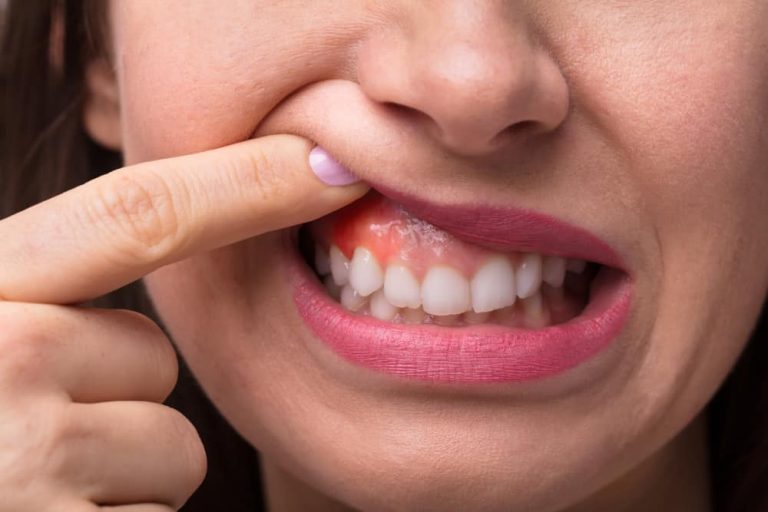 side-effects-of-deep-cleaning-dental-clinic-ang-mo-kio-bedok